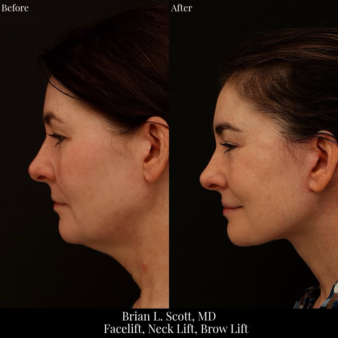 Instagram post by Dr. Brian L. Scott: This 53-year-old patient felt like she didn’t recognize the tired-looking person she saw in the mirror. She was most bothered by jowling, de…