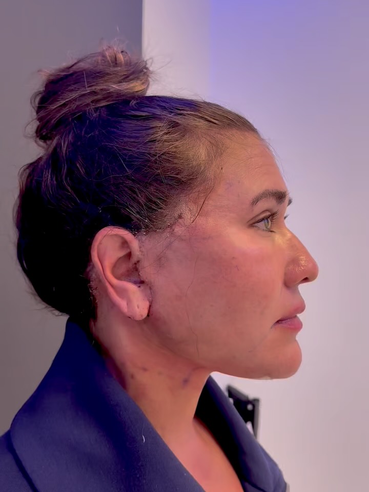 Instagram post by Dr. Brian L. Scott: Many people wonder what they will look like after a facelift. This patient in her late 40s is shown one day after an extended deep plane fac…