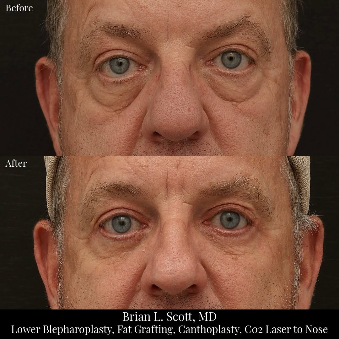 Instagram post by Dr. Brian L. Scott: This gentleman in his late 50s disliked the way his lower eyelids made him look tired despite a good nights rest. He also felt like his nose…
