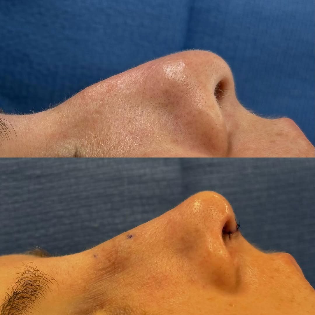 Instagram post by Dr. Brian M. Harmych: Immediate before and after primary rhinoplasty. ✅ Conservative dorsal hump reduction ✅ Reduced nasal dorsal over projection ✅ Improved nasal…