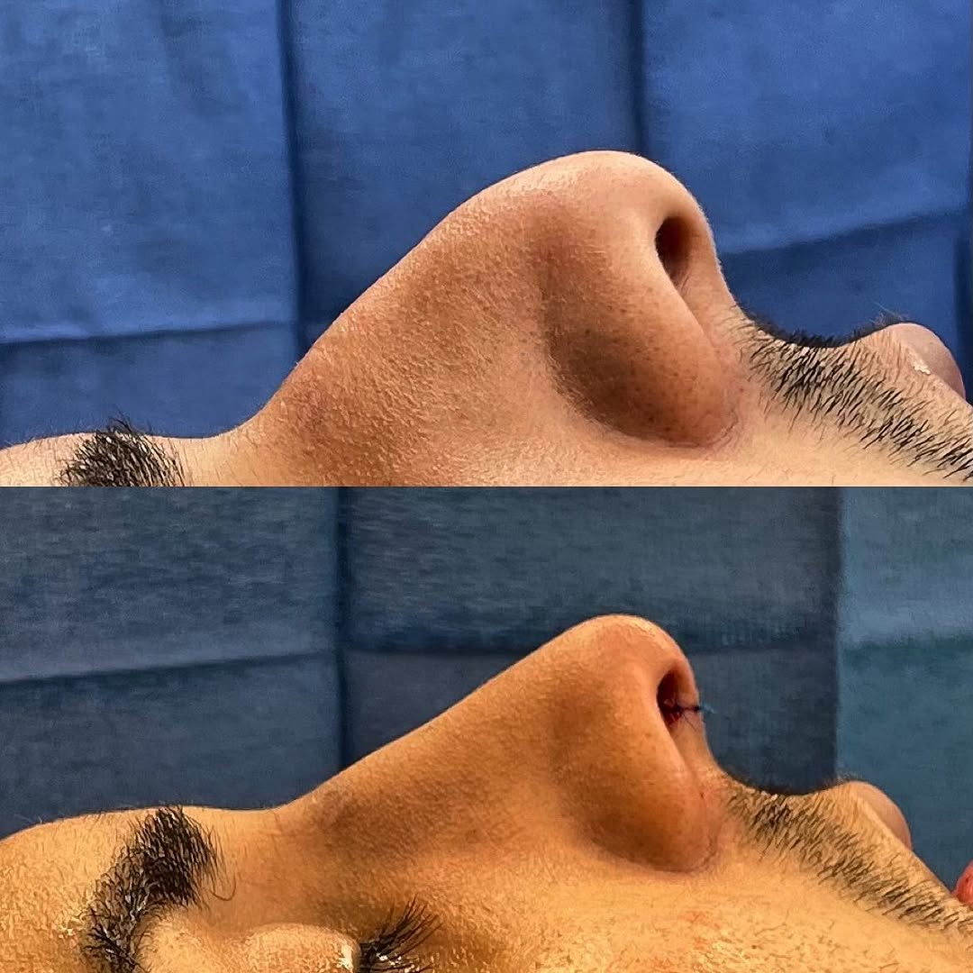 Instagram post by Dr. Brian M. Harmych: Immediately before and after #rhinoplasty ✅ dorsal hump reduction ✅ Improved nasal tip definition ✅ improved nasal tip rotation ✅ Decreased …