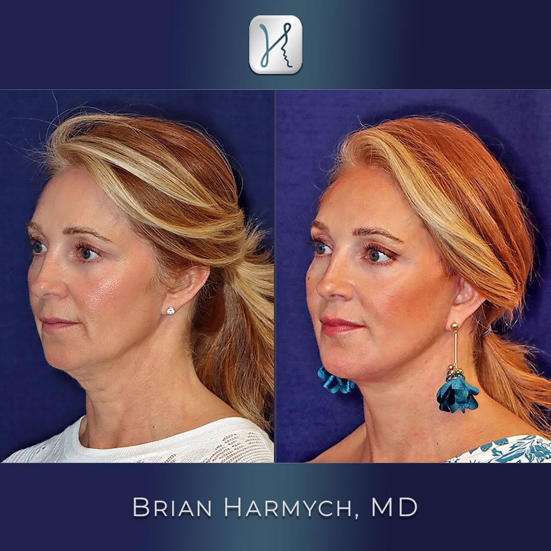 Instagram post by Dr. Brian M. Harmych: Transformative results with a deep plane facelift! ✨ The extended deep plane technique is unmatched in delivering natural, long-lasting resu…