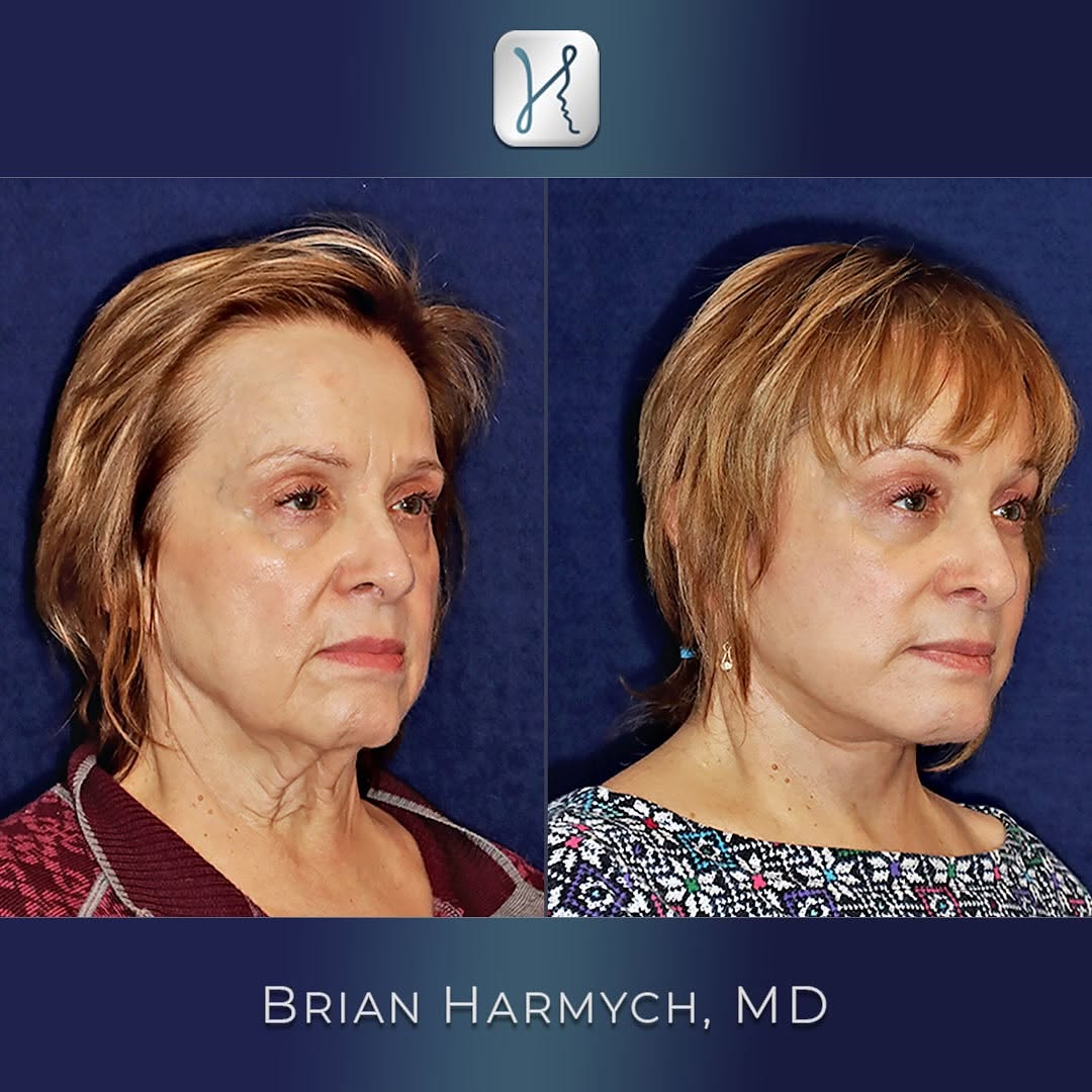 Instagram post by Dr. Brian M. Harmych: Another outstanding deep plane facelift transformation! ✨ This 66-year-old patient underwent a comprehensive facial rejuvenation, including …