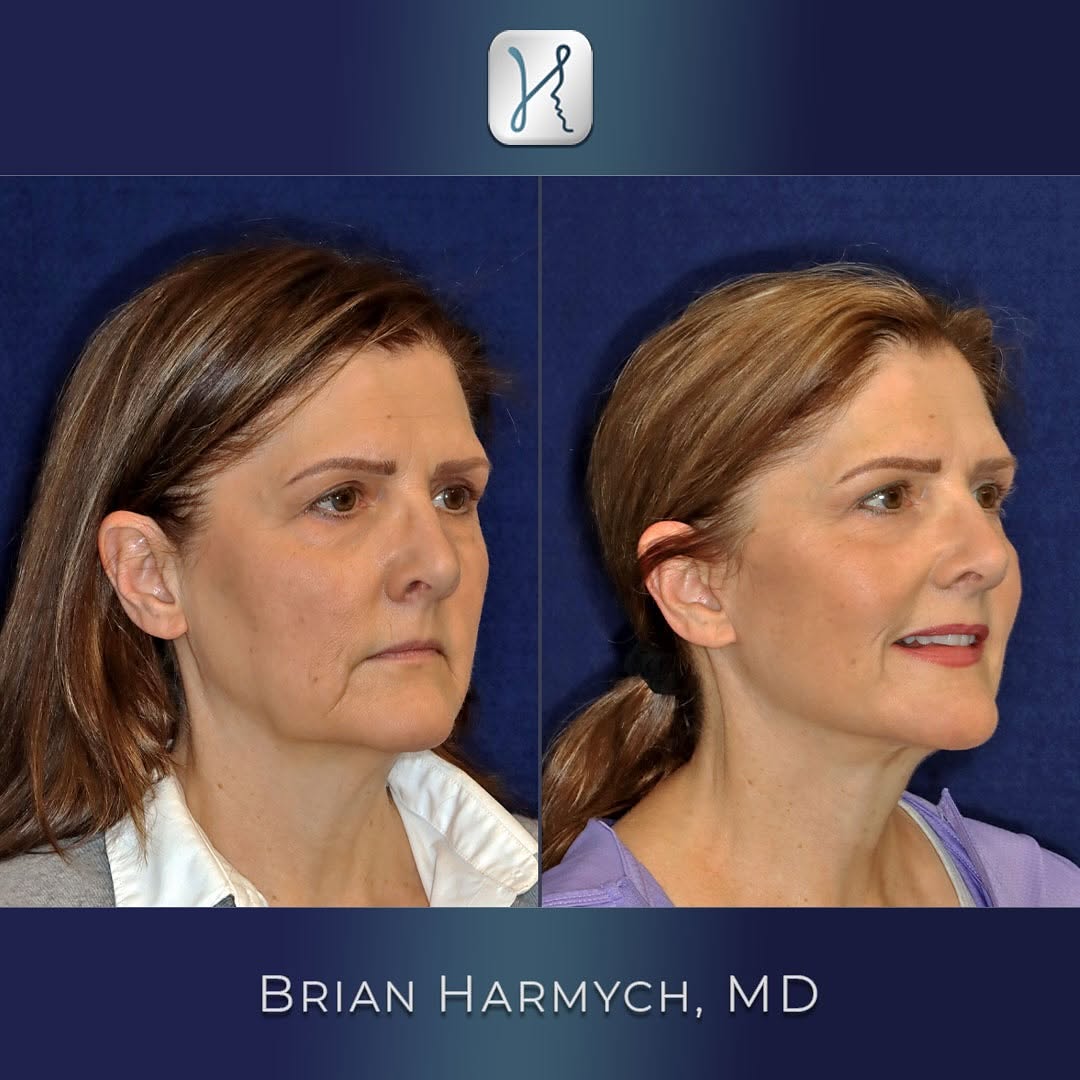 Instagram post by Dr. Brian M. Harmych: Another outstanding deep plane facelift transformation! ✨ This 60-year-old patient underwent a comprehensive facial rejuvenation, including …