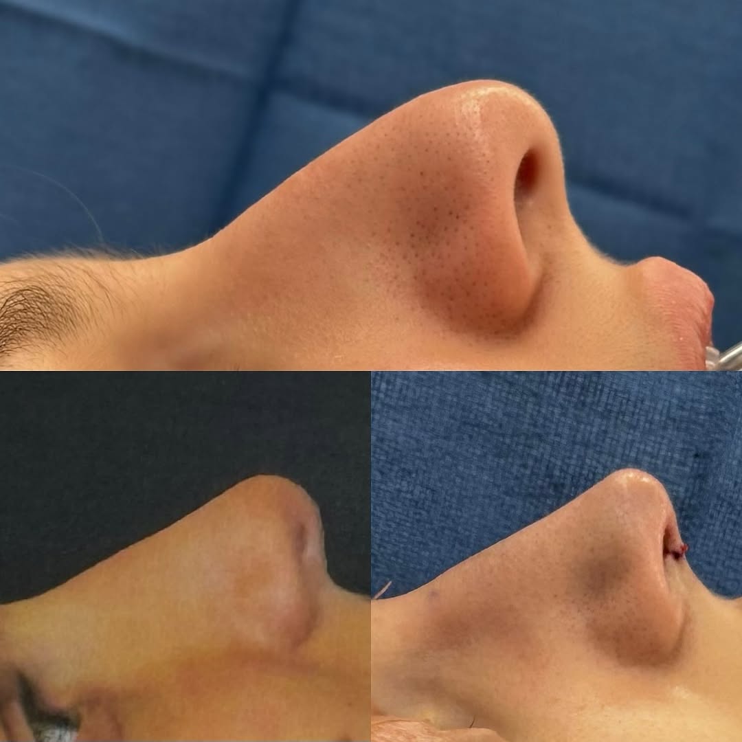 Instagram post by Dr. Brian M. Harmych: From planning to surgery! 👃 The top image shows the patient’s preoperative nose, while the bottom left image illustrates our simulated comp…