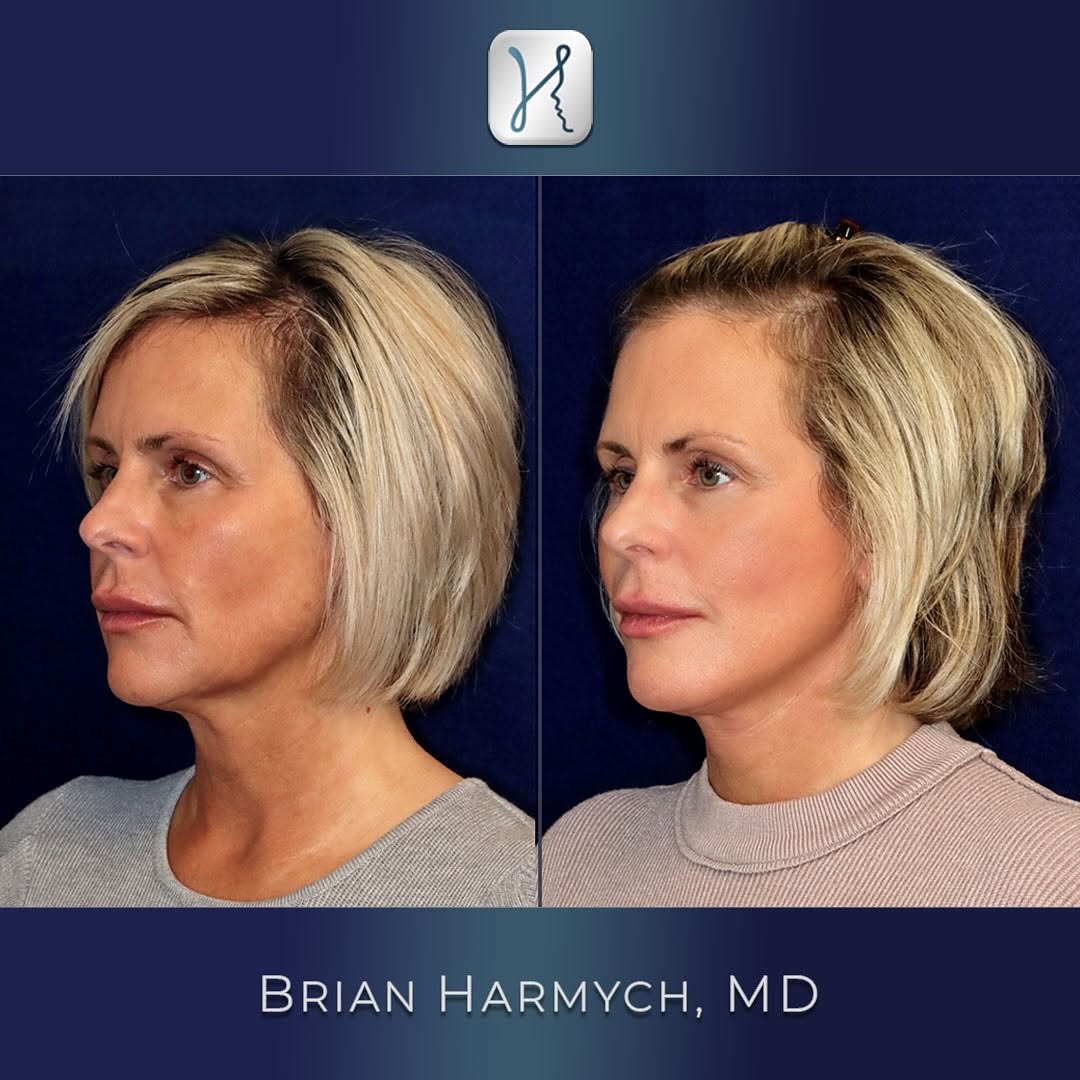 Instagram post by Dr. Brian M. Harmych: Another natural, yet profound, transformation! ✨ This 47-year-old female patient is 8 months post-op from her extended deep plane facelift, …
