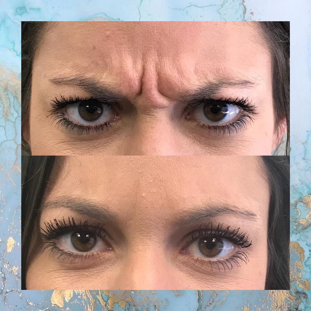 Instagram post by Dr. Brian P. Tierney: Amazing results!! Before & after botox at Tierney Plastic Surgery! 💉