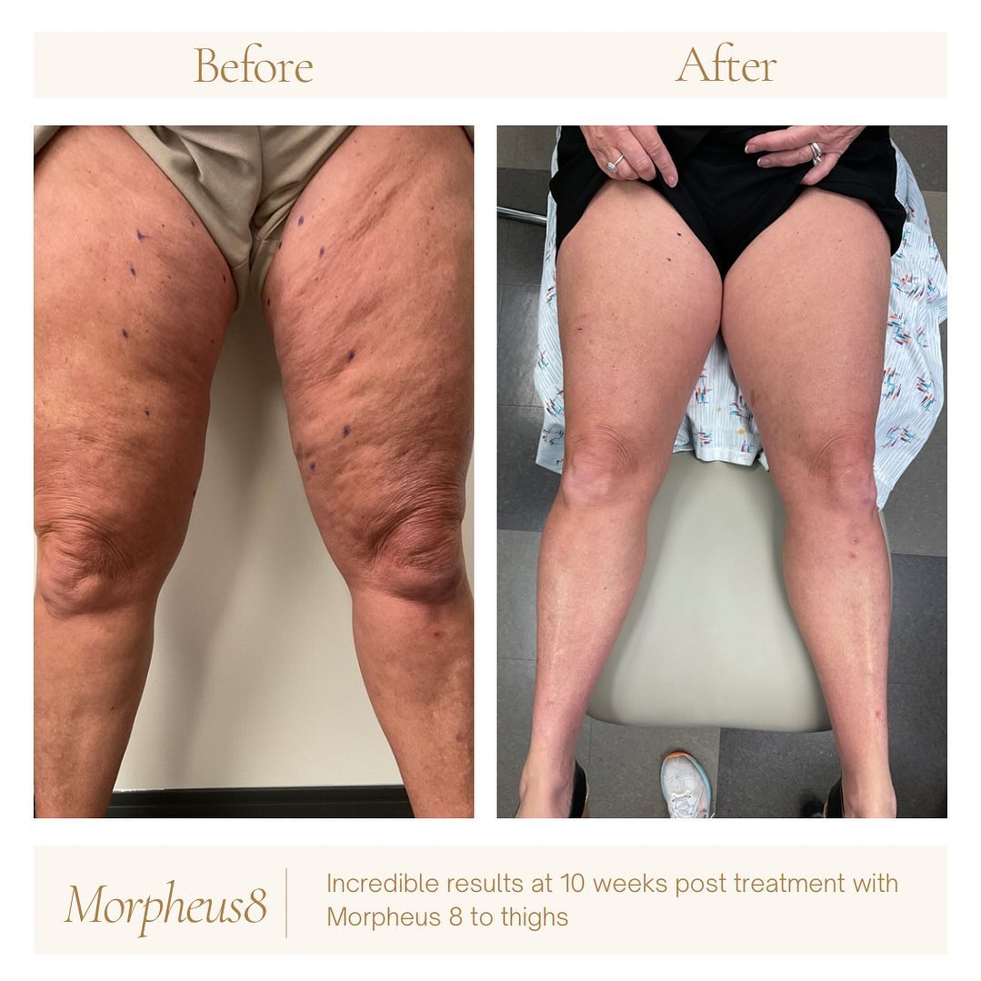 Instagram post by Dr. Brian P. Tierney: Incredible results from @inmodeaesthetics Morpheus8! TO BOOK!👇 📞 Call: 615-320-8585 📱 DM: If you have any questions! 💻 Visit: TierneyMD.…