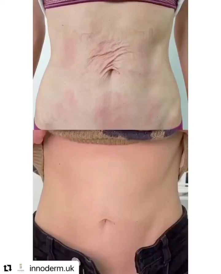 Instagram post by Dr. Brian P. Tierney: Repost from @nashville_inmode 🤩 ✅Handsfree Skin Tightening ✅Handsfree Fat Melting ✅Handsfree Muscle Toning ✅Zero Pain ✅Zero Downtime ✅Zero …
