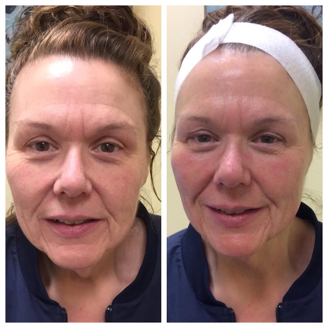 Instagram post by Dr. Brian Raphael: Hydrated, glowing, and ready for the week! Our hydra facial before and after pictures speak for themselves! Painless & quick, these facials …
