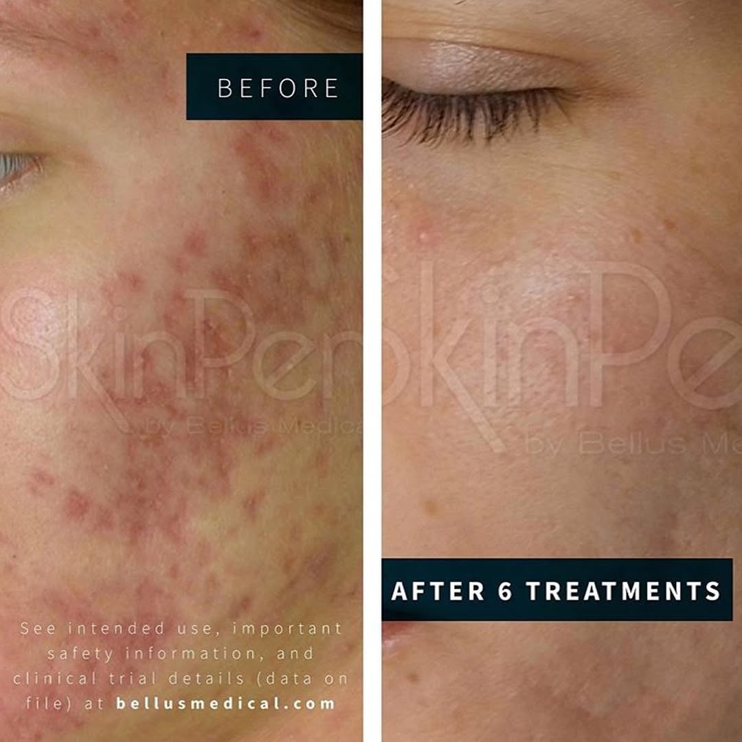 Instagram post by Dr. Brian Raphael: SkinPen was awarded “Top Rated Treatment for Acne Scars” and “Top Skin Care Device” in the Aesthetic Everything Cosmetic Medicine 2019 Award…