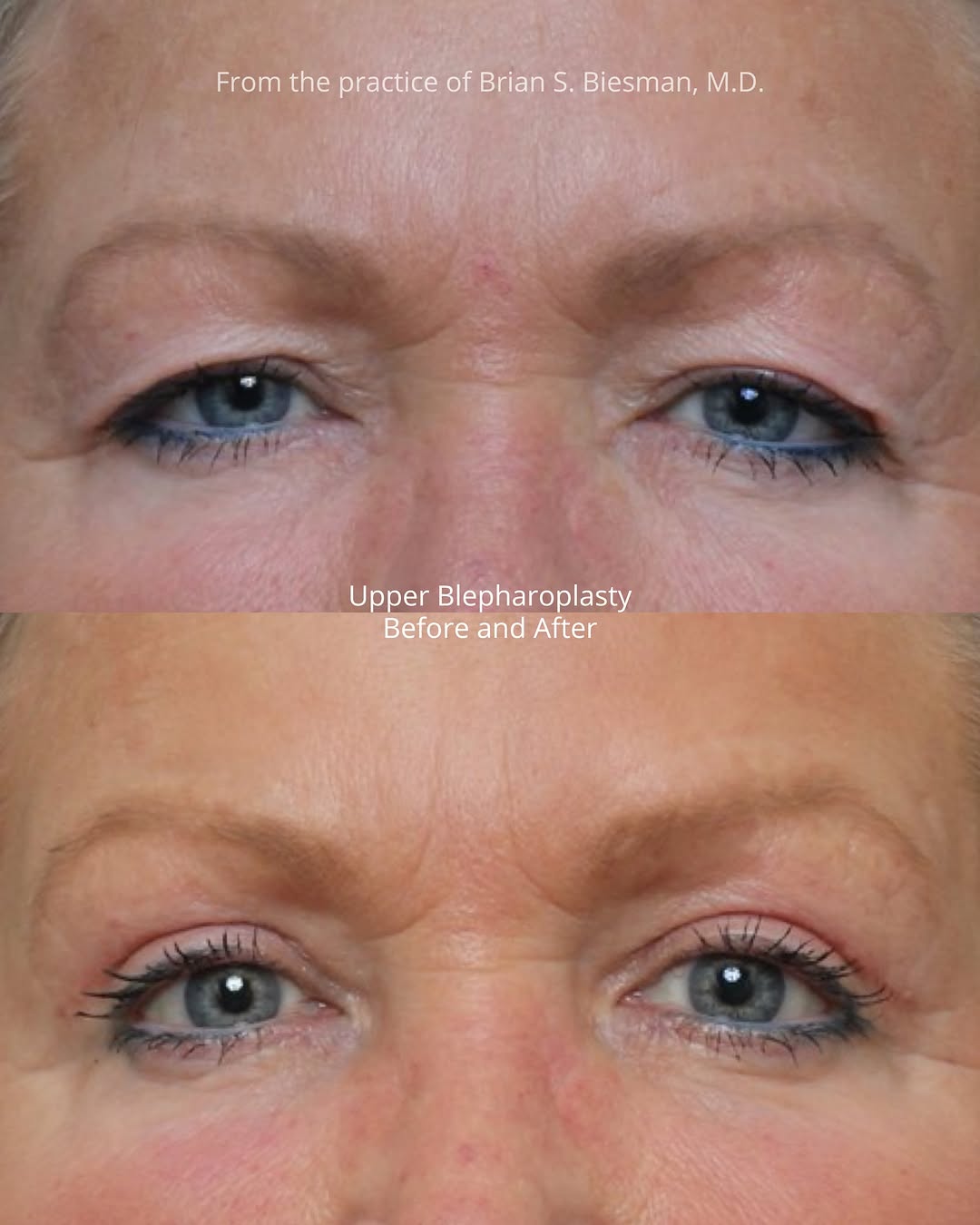 Instagram post by Dr. Brian S. Biesman: While most patients require a combination of eyebrow recontouring, blepharoplasty, and ptosis repair for optimal upper eyelid rejuvenation, …