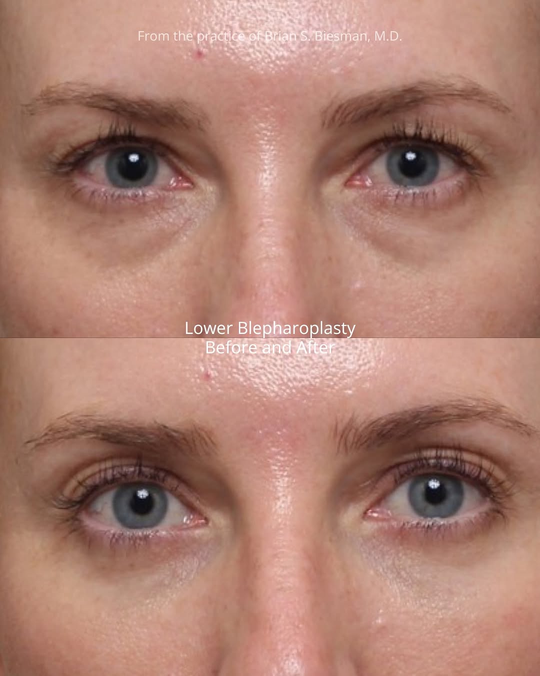 Instagram post by Dr. Brian S. Biesman: Under-eye bags aren’t usually something skincare, lasers, or injectables can fix. When protruding lower eyelid fat is the underlying issue, …