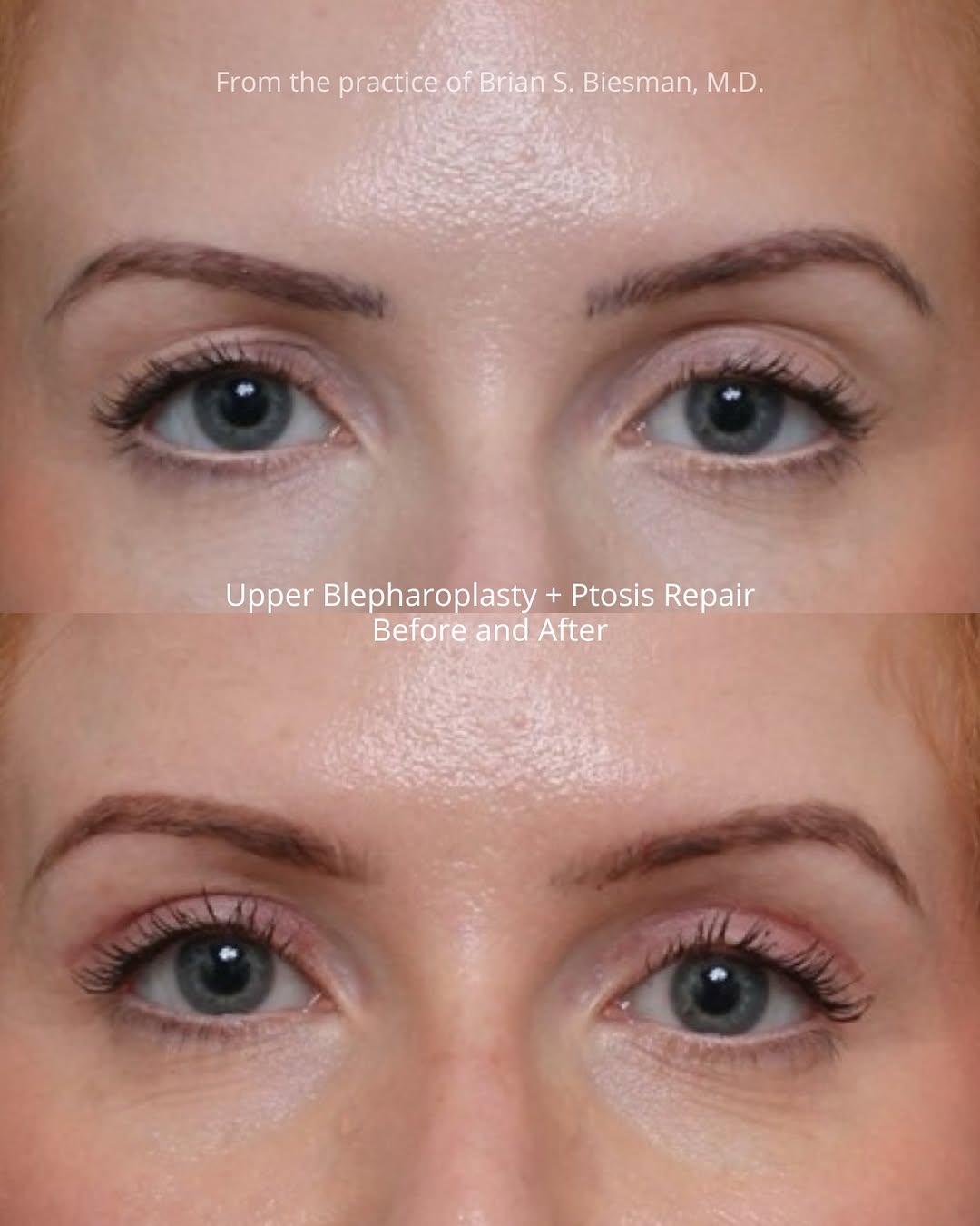 Instagram post by Dr. Brian S. Biesman: It doesn’t take long to start seeing the payoff from eyelid surgery. This patient’s beautiful after photos were taken just one month after u…