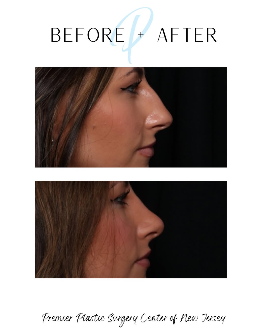 Instagram post by Dr. Brian S. Glatt: This patient presented to Dr. Glatt with complaints of prominent nasal dorsum and was seeking cosmetic improvement for this. Dr. Glatt perfo…
