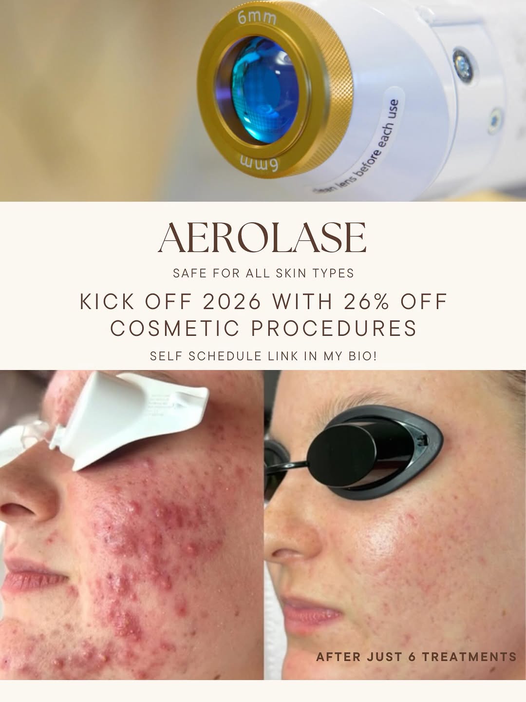 Instagram post by Dr. Brittany Carter-Snell: One laser. So many solutions. The Aerolase Neo is a gentle, advanced laser that safely treats active acne, acne scars, rosacea, hyperpigment…