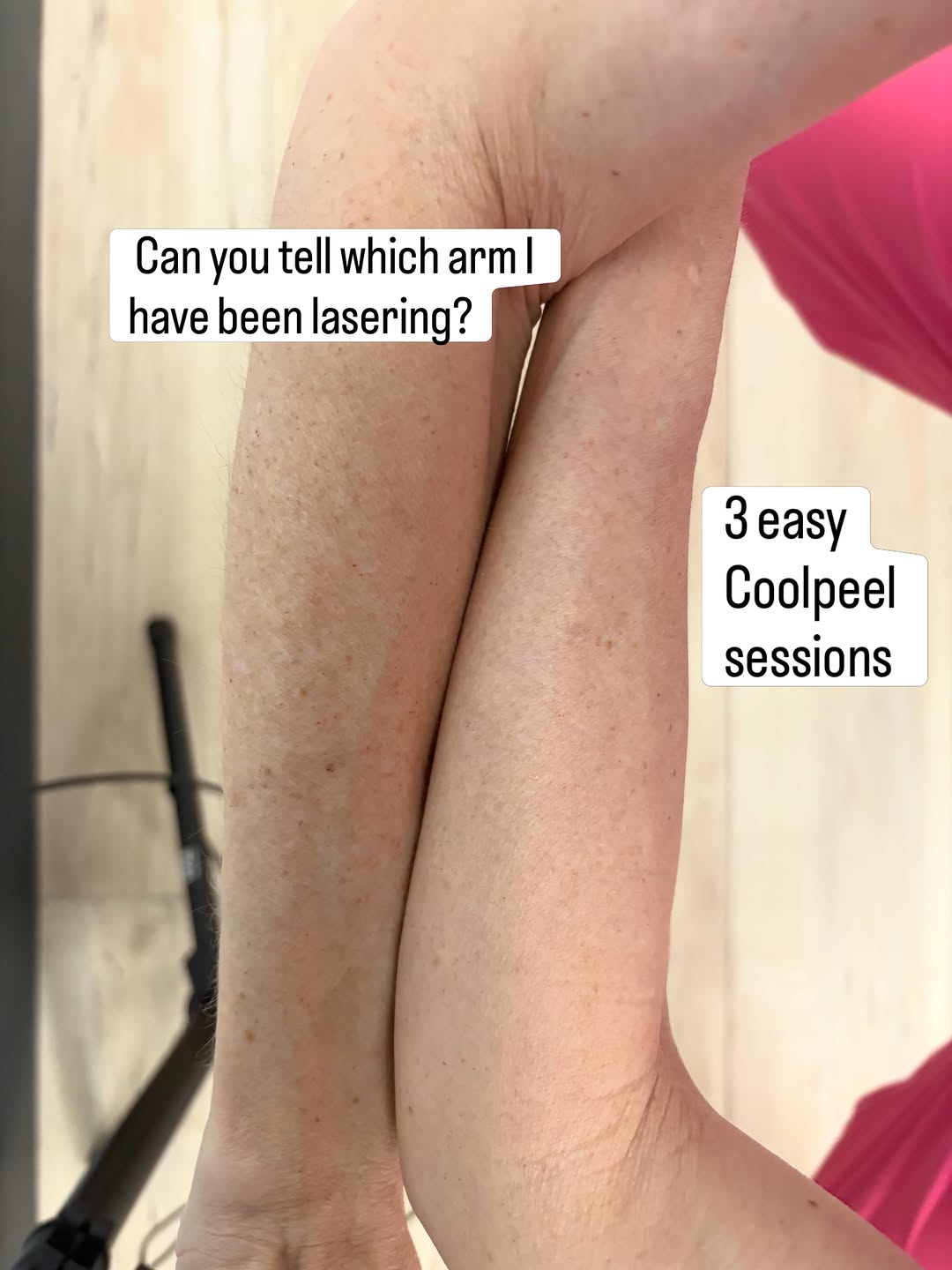 Instagram post by Dr. Brooke Jeffy: Can you tell which arm I have been lasering? I am starting a body wide co2 journey. #coolpeel