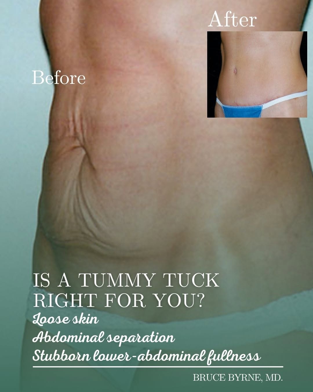 Instagram post by Dr. Bruce A. Byrne: A tummy tuck isn’t a weight-loss procedure, and it isn’t necessarily about reaching a “perfect” number on the scale. The best candidates are…