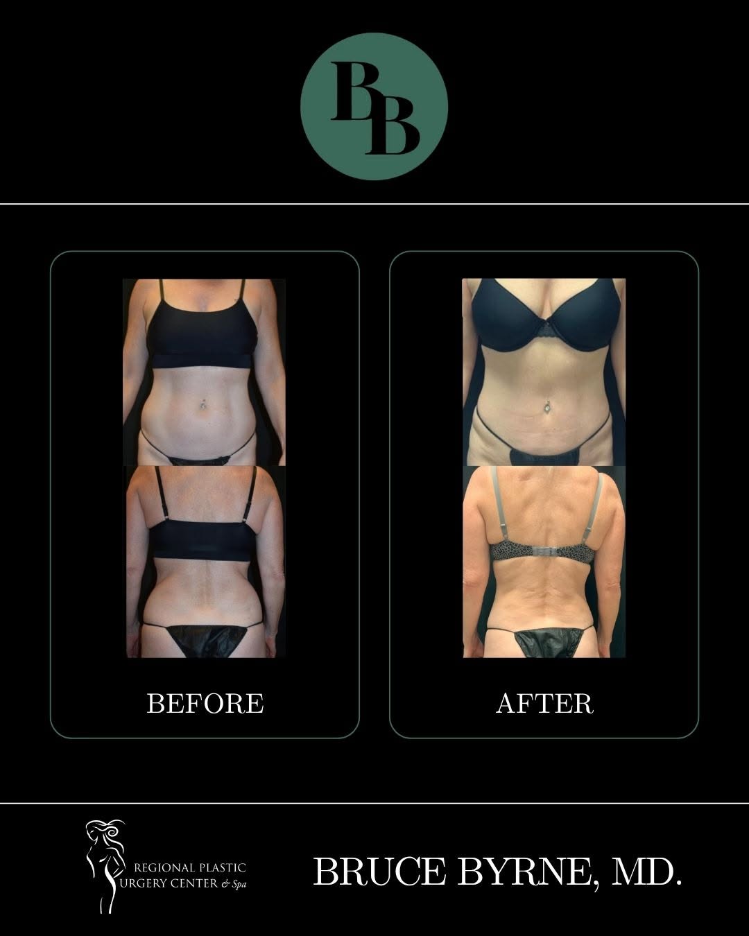 Instagram post by Dr. Bruce A. Byrne: Liposuction can be a great option for refining multiple areas and creating a more balanced, contoured silhouette. For this patient, Dr. Byrn…