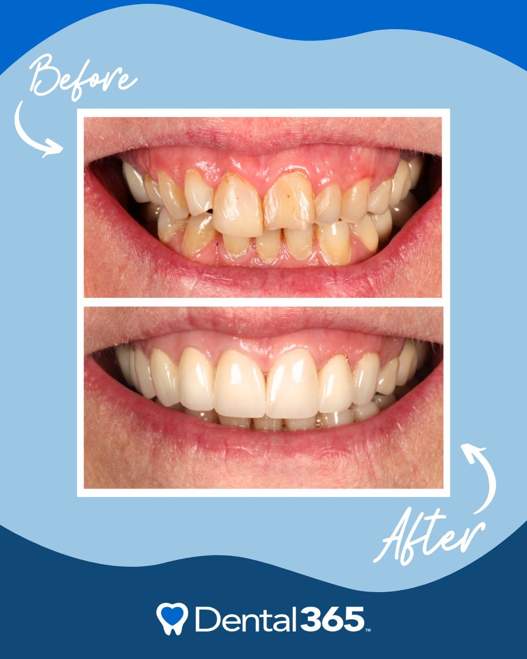 Instagram post by Dr. Bruce Freund, DDS: A renewed smile can make all the difference ✨ From chipped and worn teeth to a brighter, more balanced smile, this transformation highlights…