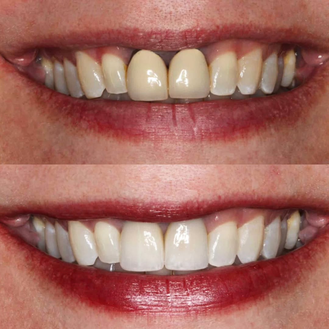 Instagram post by Dr. Bruce Wilderman, DDS: One or two teeth can make all the difference! For this smile makeover, Dr. K was able to give this patient a whole new smile by just fixing …