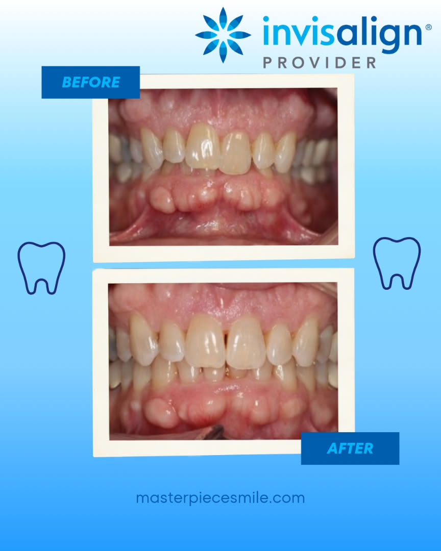 Instagram post by Dr. Bruce Wilderman, DDS: No words needed to describe this incredible transformation with the help of Invisalign, and the guidance of Dr. K! Come find confidence in y…