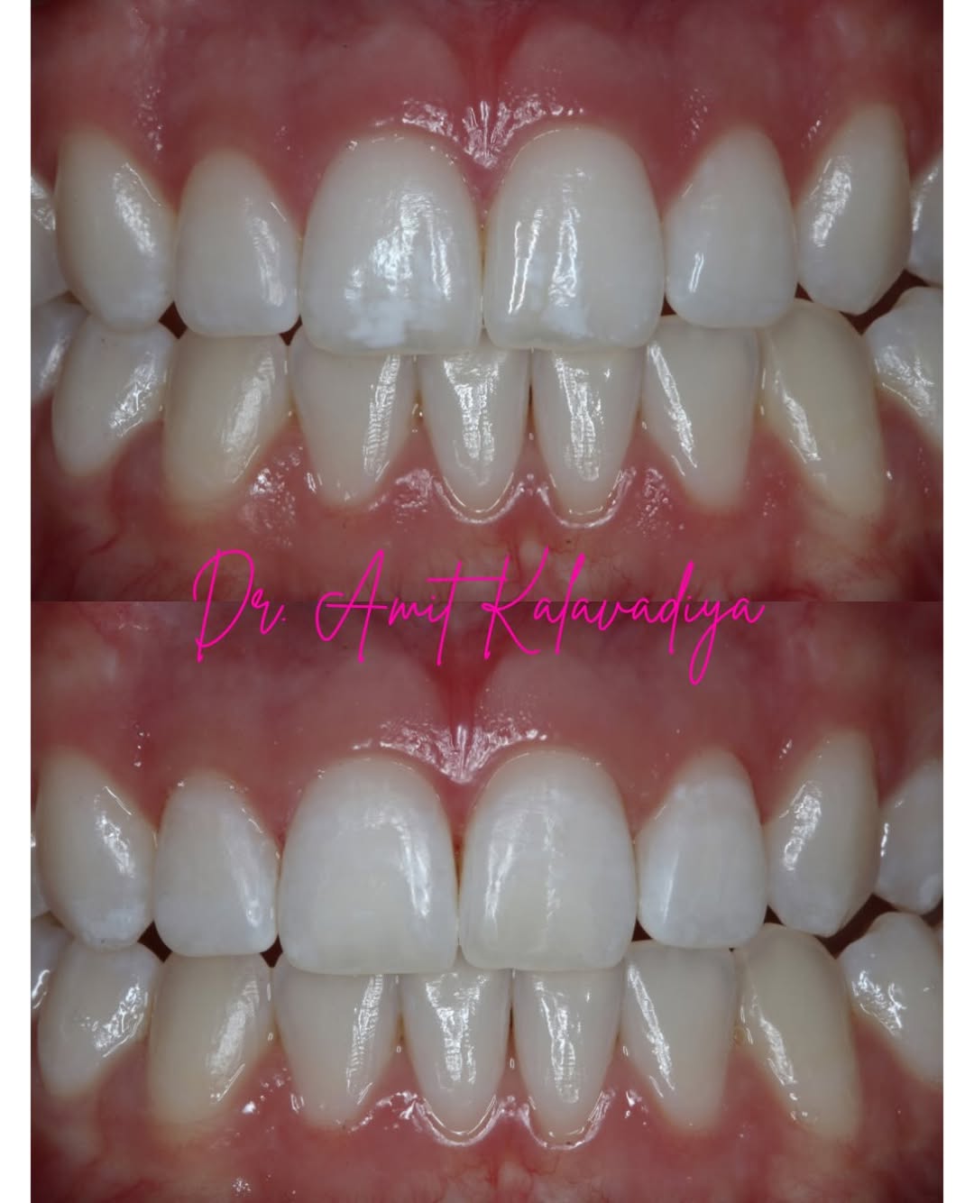 Instagram post by Dr. Bruce Wilderman, DDS: ✨ Before ➡️ After ✨ 🦷 White spots after braces or orthodontic treatment can be frustrating, and they’re not easy to remove. But with the ri…