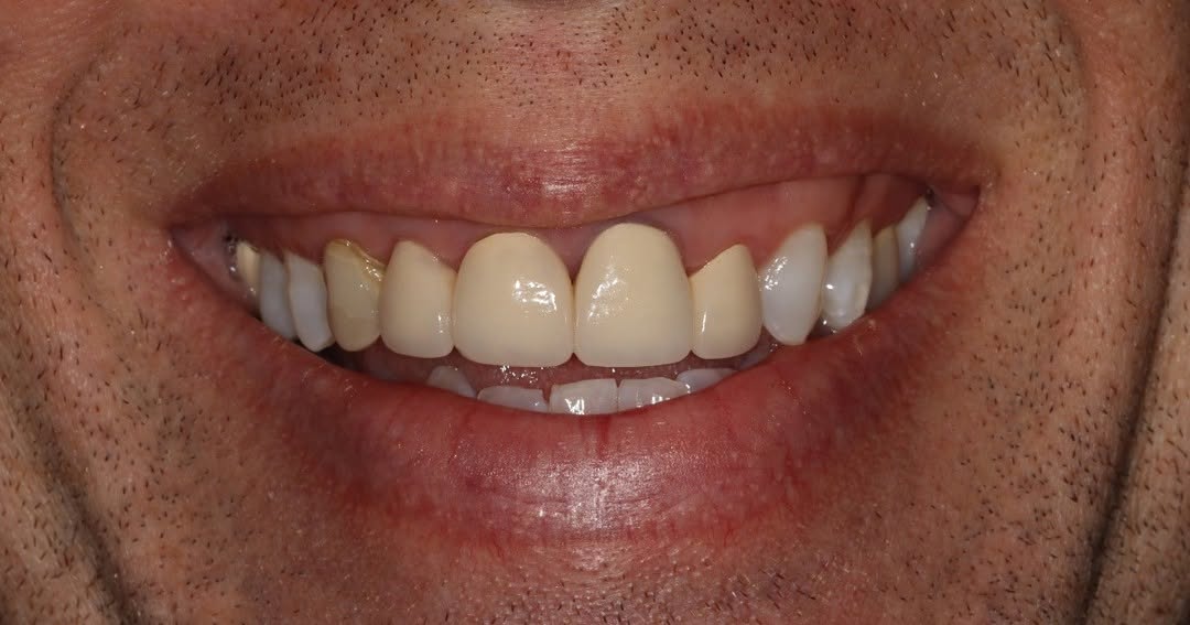 Instagram post by Dr. Bryan Brenner, DDS: This transformation wasn't about creating a completely different smile. It was about restoring balance, improving function, and creating a r…