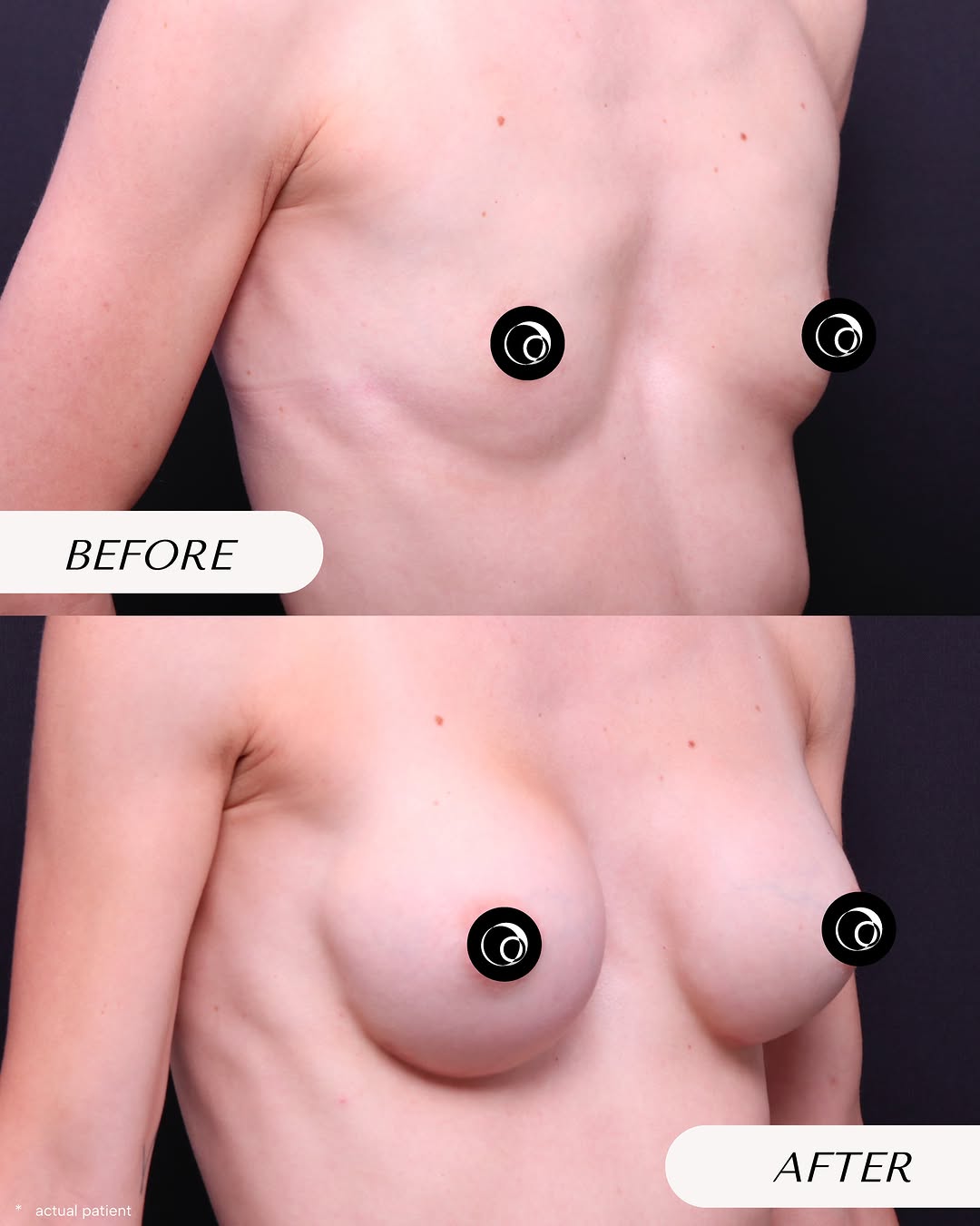 Instagram post by Dr. Bryan Rolfes: Breast augmentation 🤍 A beautiful example of how breast augmentation can be customized to enhance volume, shape, and balance. • Left side: …