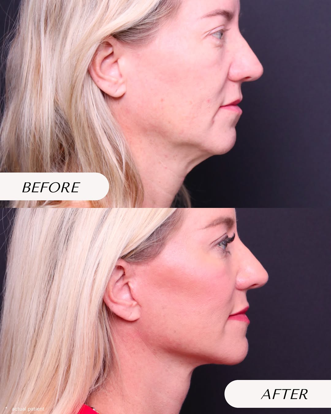 Instagram post by Dr. Bryan Rolfes: This transformation combined a deep plane face & neck lift, lateral temporal brow lift, and CO₂ laser resurfacing to address both deeper str…