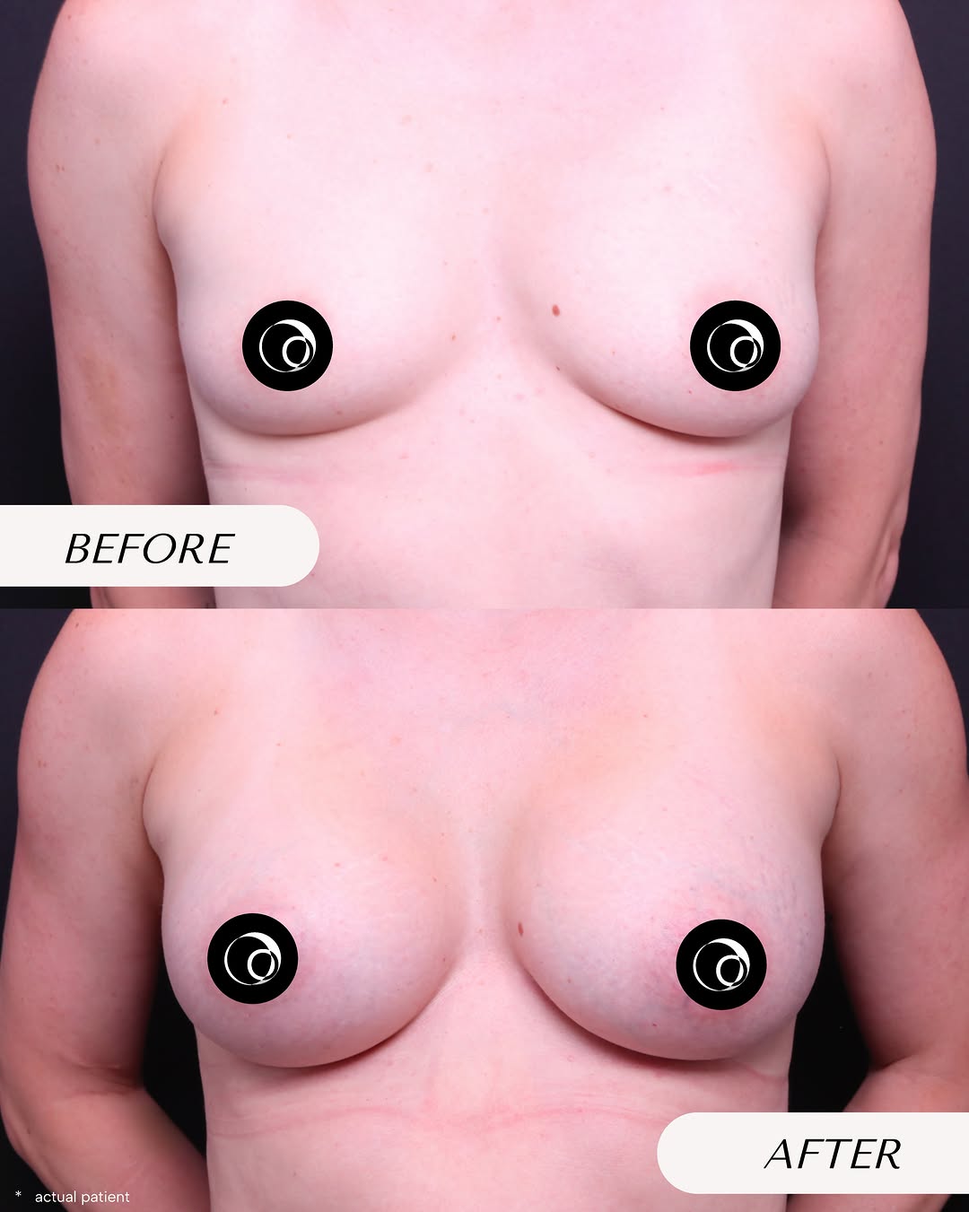 Instagram post by Dr. Bryan Rolfes: Breast Augmentation | 1 Year Post-Op A beautiful one-year result following bilateral breast augmentation, with implant selection tailored to…