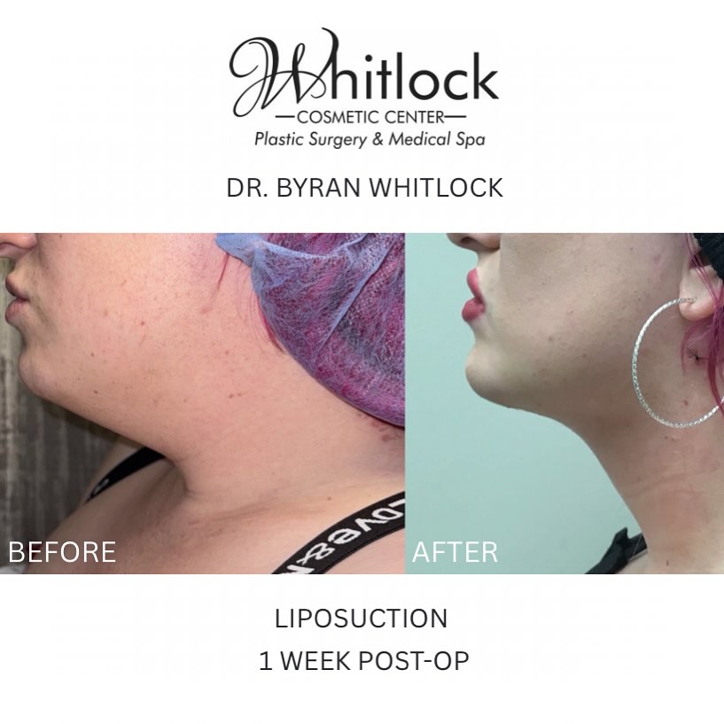Instagram post by Dr. Bryan Whitlock: Snatched by Dr. Whitlock 🔥 This is just one week post-op—most swelling fades over the first 3 months, with full results in 6–12. Patient is…