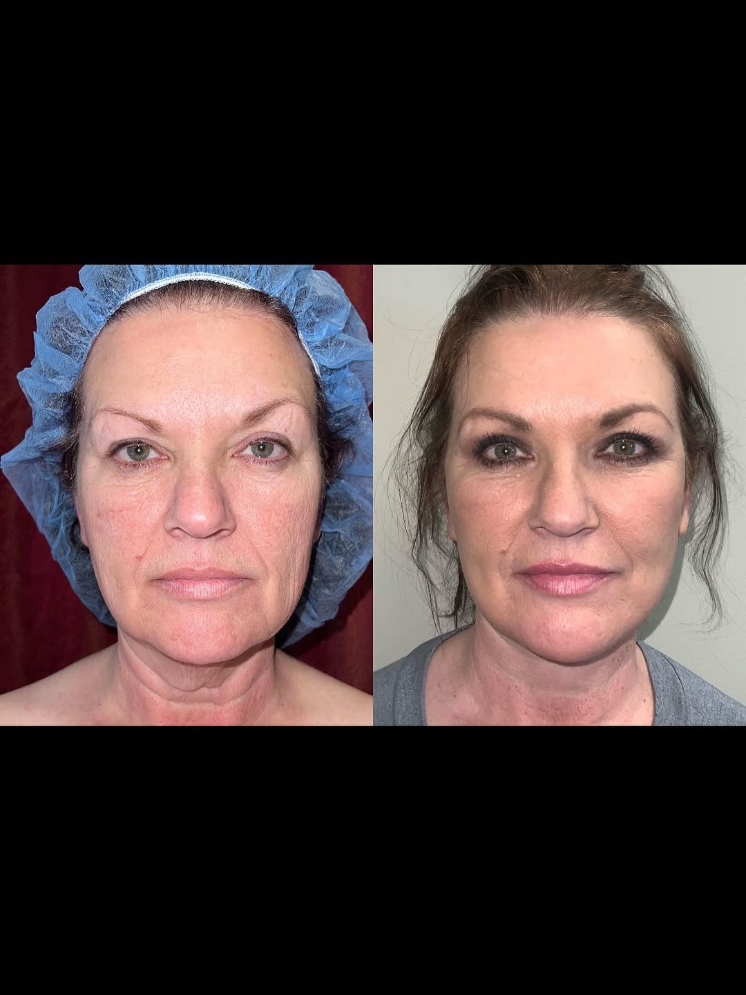 Instagram post by Dr. Bryan Whitlock: Ever glance in the mirror and wonder who’s staring back? You feel young, but your reflection says otherwise. Dr. Whitlock can help you look …