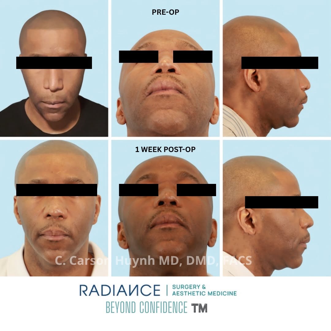 Instagram post by Dr. C. Carson Huynh, MD, D: Revision Rhinoplasty ✨ This patient was unhappy with results after his primary rhinoplasty elsewhere that resulted in severe collapse and as…