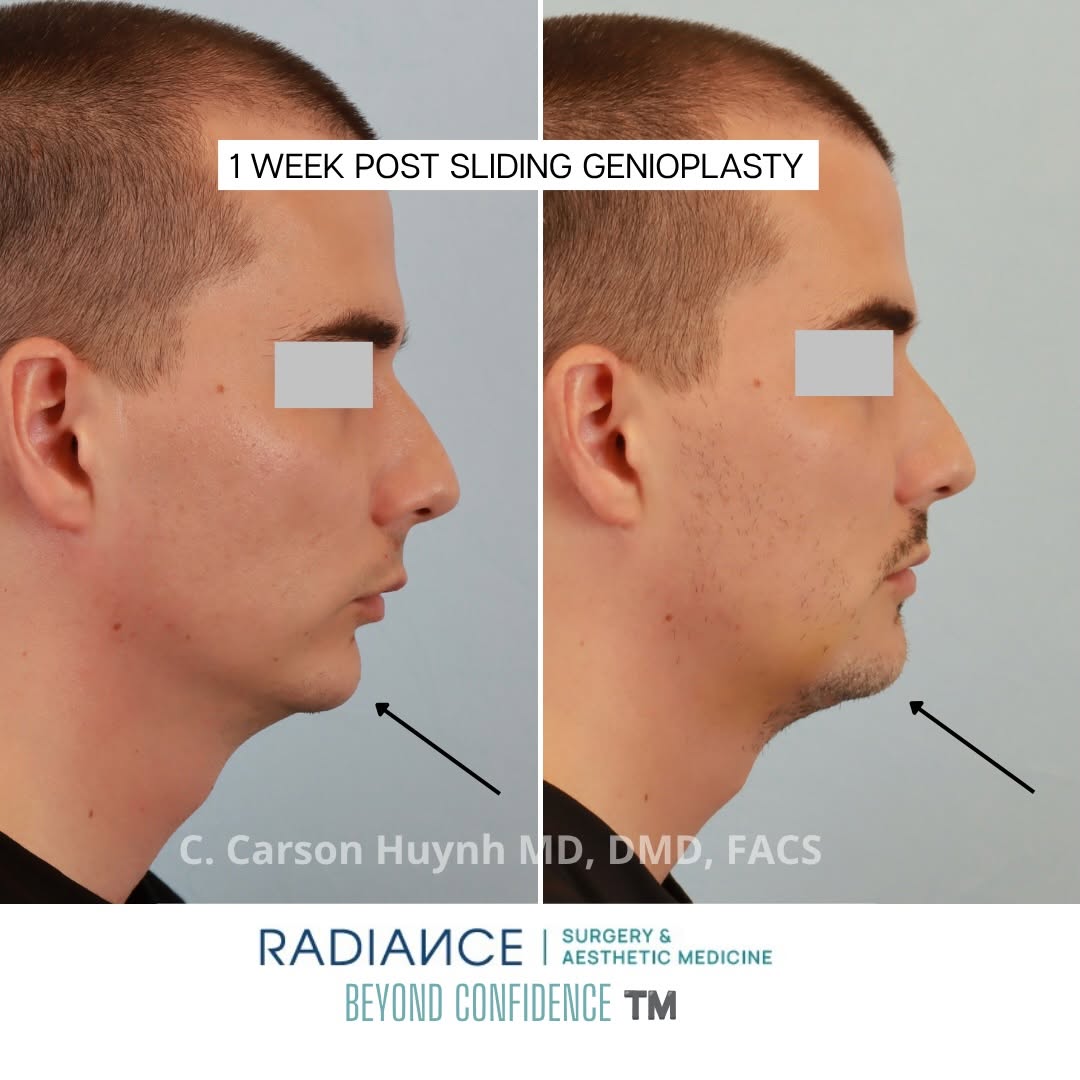 Instagram post by Dr. C. Carson Huynh, MD, D: Weak chin? Watch what happens when projection is restored the right way. ✅ 1 week post sliding genioplasty. Notice the refined labial-mental…