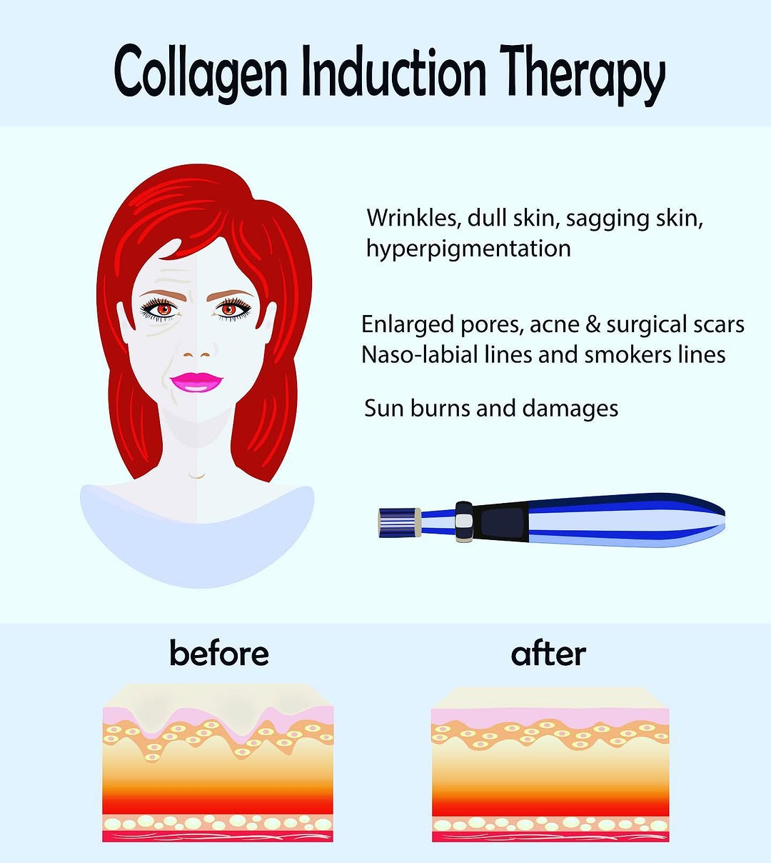 Instagram post by Dr. Calvin Van Reken: Did you know that microneedling is also known as “collagen-induction therapy”? Look at these many amazing benefits 😍😱😱😱😱. Book your ses…