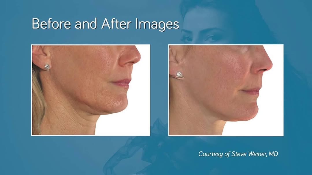 Instagram post by Dr. Calvin Van Reken: Infini radiofrequency insystem combines microneedling technology with fractional radiofrequency to stimulate collagen production, helping to…