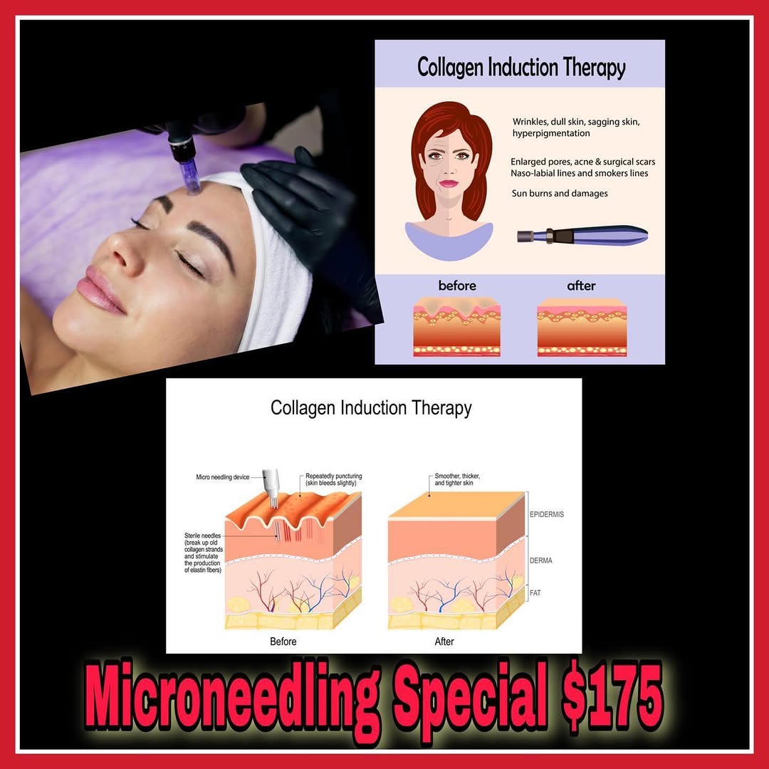 Instagram post by Dr. Calvin Van Reken: 🌻 MICRONEEDLING SPECIAL Only $175 per session (Value $225) Microneedling induces collagen production, tightens the skin, improves the appea…