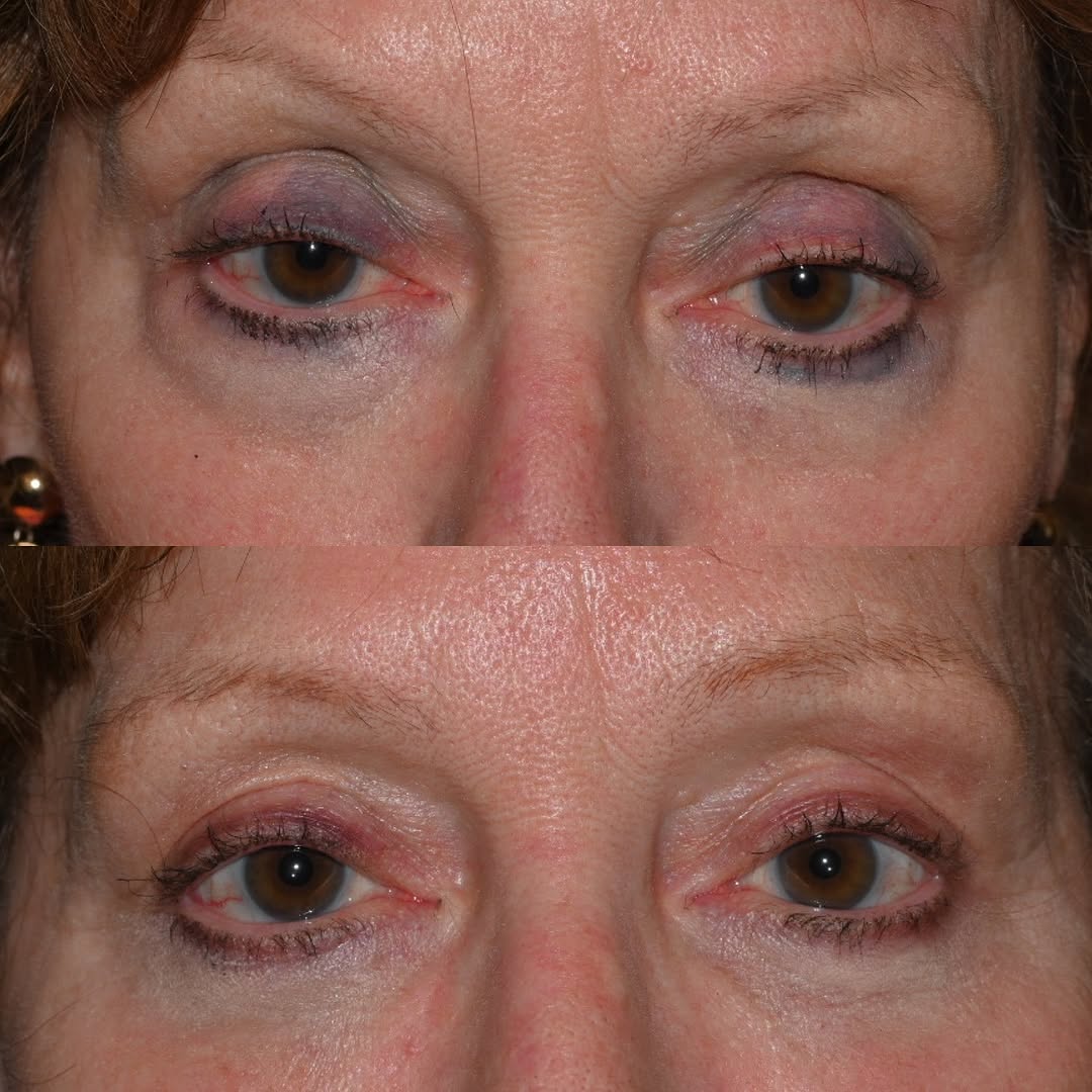Instagram post by Dr. Cameron Nabavi: ✨ Refreshed. Rested. Rejuvenated. ✨ This patient underwent an upper lid ptosis repair (to lift heavy or drooping lids that can affect vision…