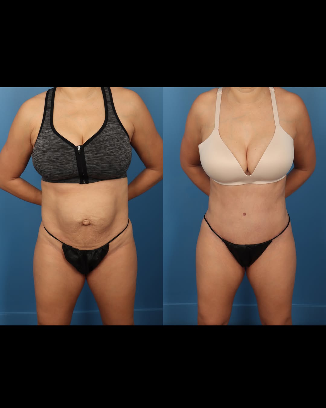 Instagram post by Dr. Cameron S. Francis: Pregnancy usually results in a midline separation of the abdominal muscles called a rectus diastasis.✨ While this is a great way to make roo…