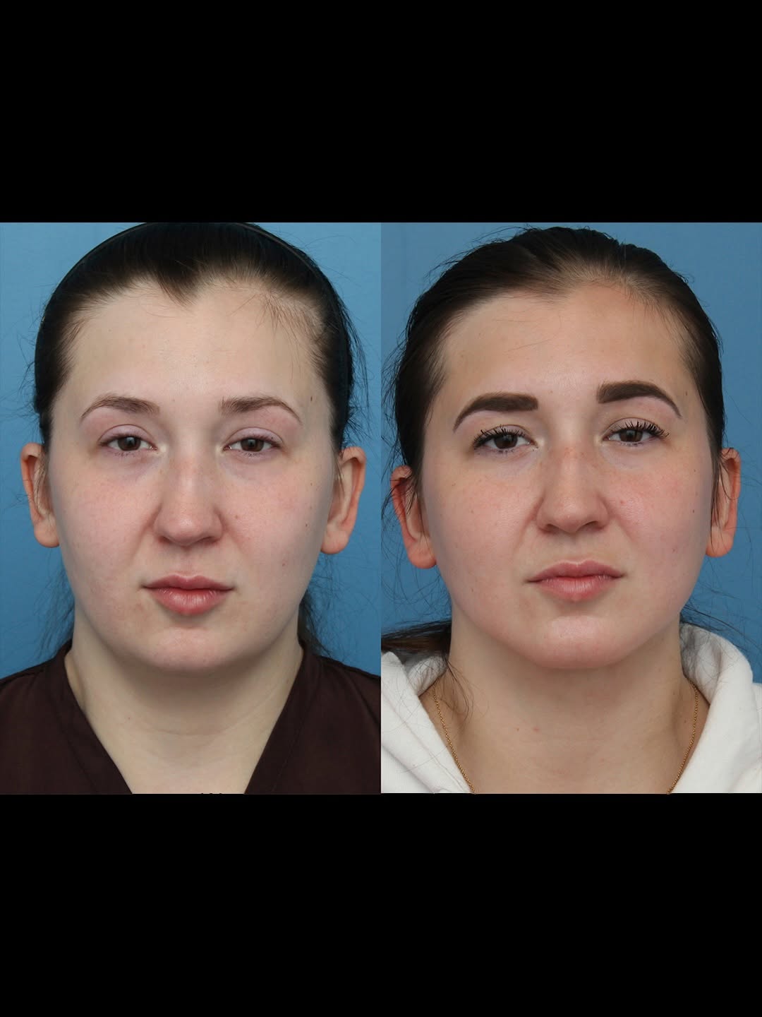 Instagram post by Dr. Cameron S. Francis: ✨ Submental liposuction is an amazing procedure for contouring the jawline and creating better facial harmony in the chin area. You’d think …