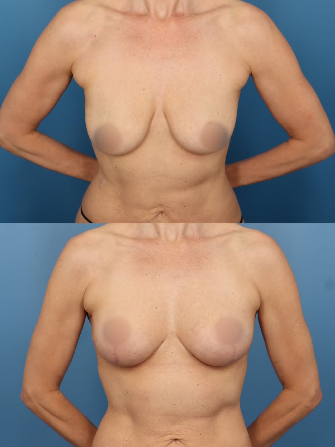 Instagram post by Dr. Cameron S. Francis: ✨ What if I told you this transformation didn’t involve implants? This 44-year-old patient experienced breast deflation and sagging after nu…