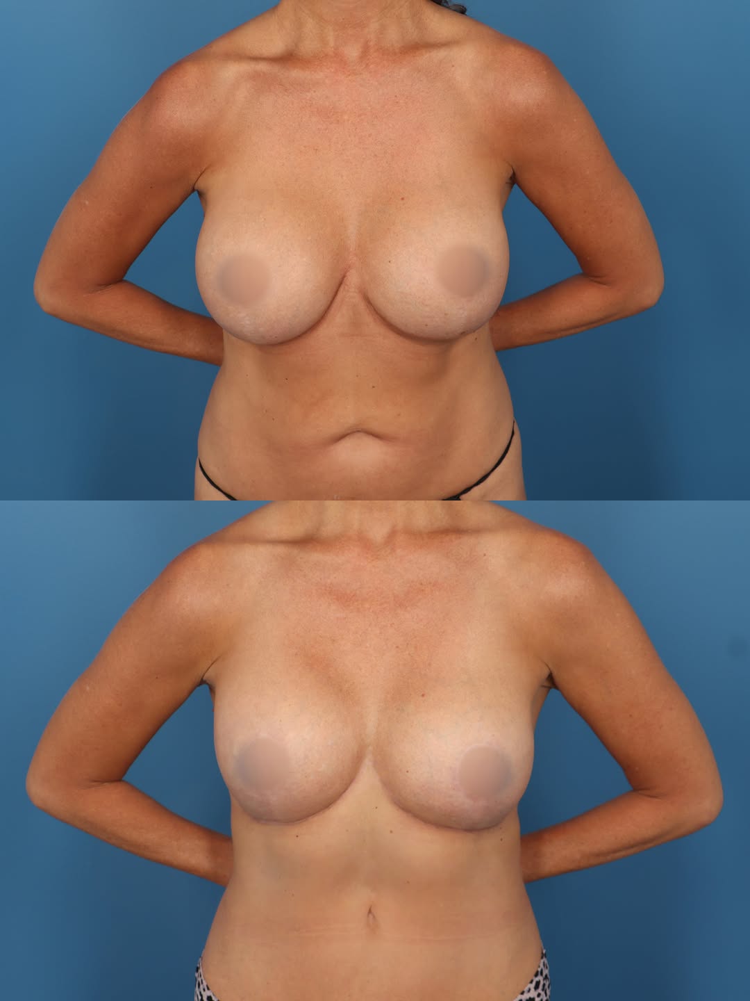 Instagram post by Dr. Cameron S. Francis: ✨ Check out this beautiful transformation with a reverse tummy tuck and breast revision. Larger breast implants may have their time and plac…