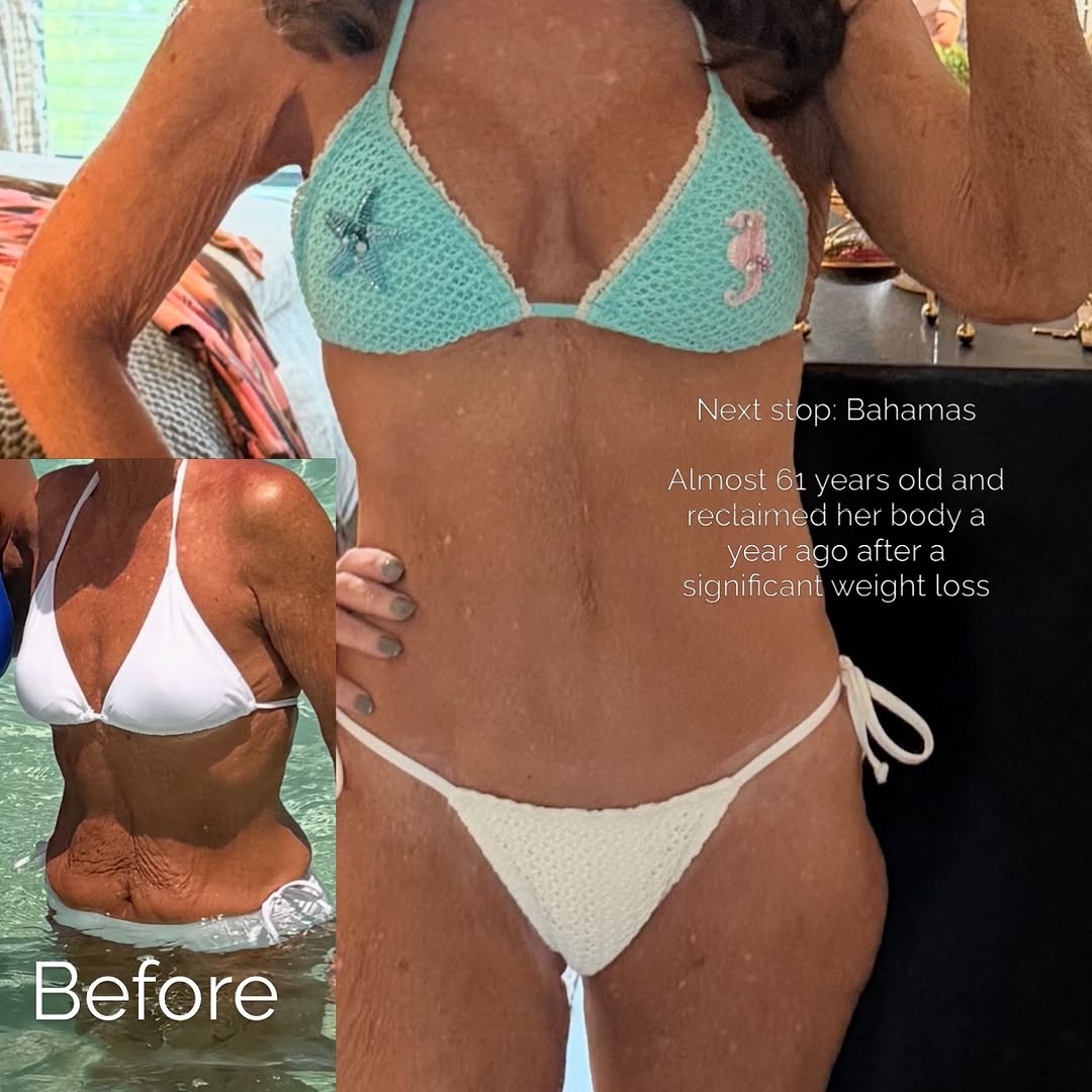 Instagram post by Dr. Carey Campbell: A check in today from down South. This amazing woman put the work in and with the help of GLP-1, lost a significant amount of weight. She ca…
