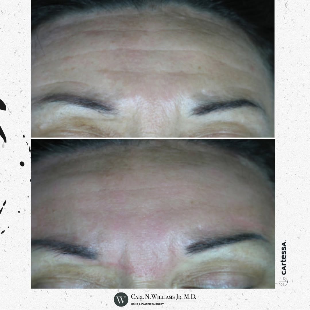 Instagram post by Dr. Carl N. Williams, Jr.: ➡️ What a little Tetra w/ CoolPeel can do for you. Wrinkles can be tamed and minimized with our Tetra CoolPeel Technology (along with many o…