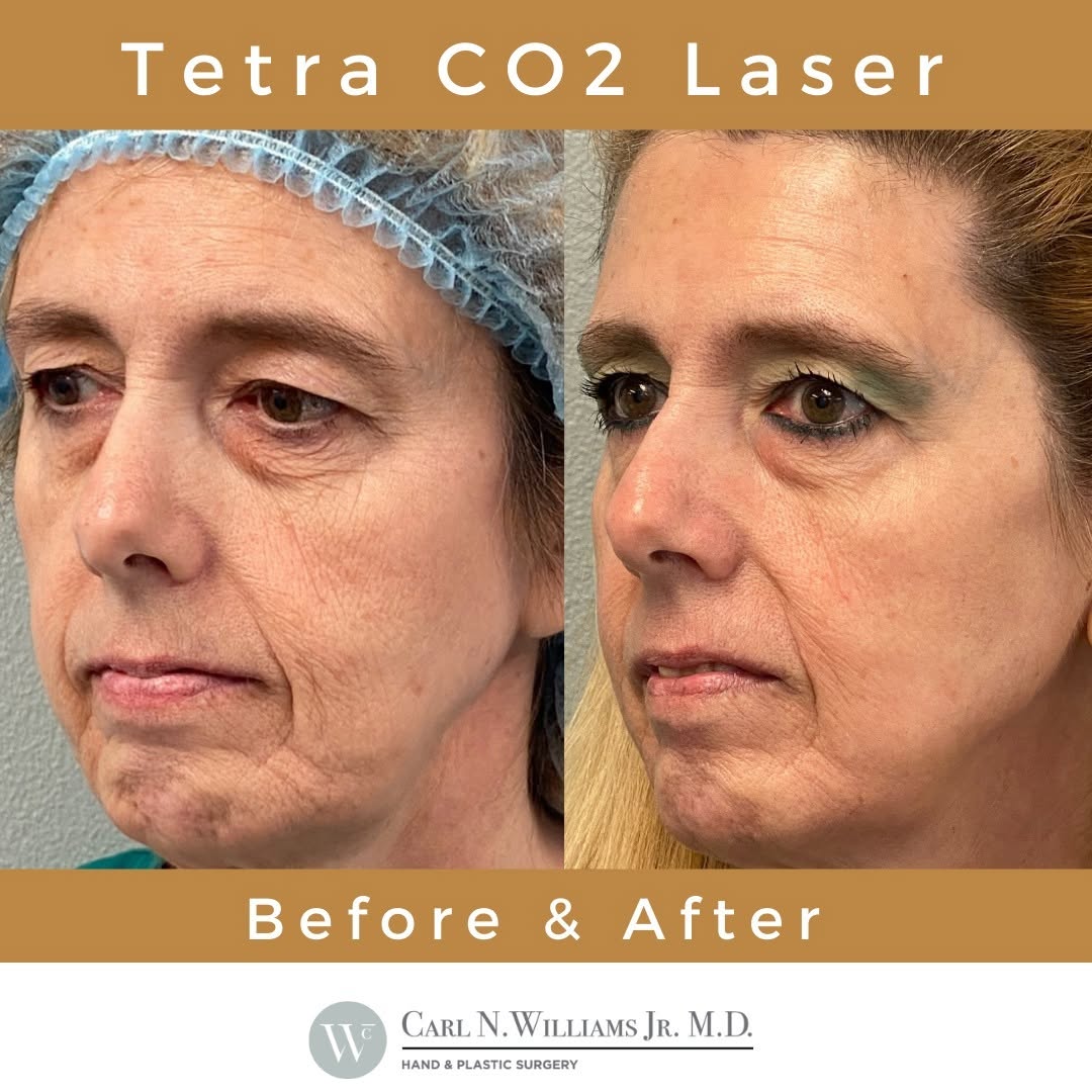 Instagram post by Dr. Carl N. Williams, Jr.: 👆This is just ONE treatment ... 👉 Tetra CO2 (with CoolPeel) can reduce the appearance of fine lines and wrinkles, irregular pigmentation a…