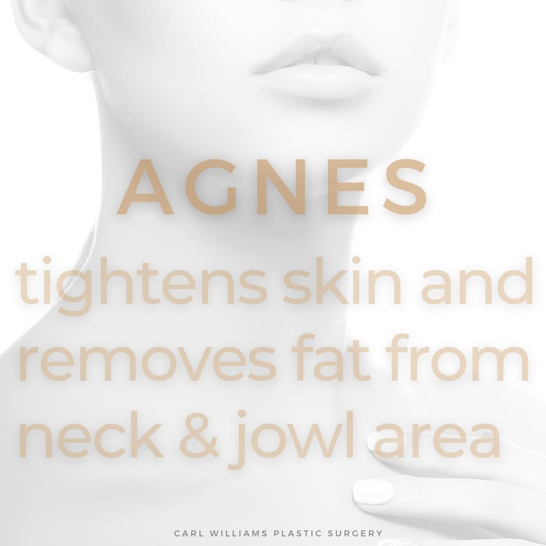 Instagram post by Dr. Carl N. Williams, Jr.: ▪️ Double Chin Fat Treatment ▪️ The Agnes RF reveals impressive results when treating a ‘double chin’. The micro-insulated needles deliver r…