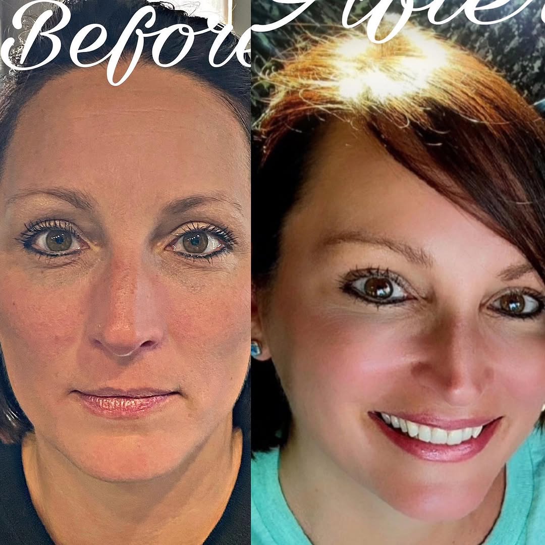 Instagram post by Dr. Carl N. Williams, Jr.: Lip filler doesn’t mean 🦆lips! A conservative treatment may be just what you are looking for to get your younger lips back! #lipfillerbefor…