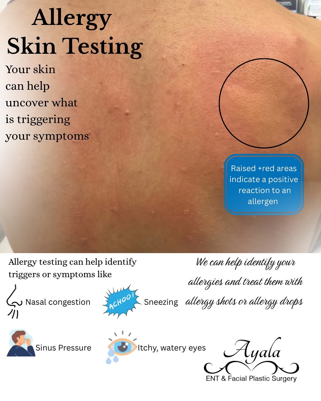 Instagram post by Dr. Carlos Ayala: 🤧 What’s triggering your allergy symptoms? Allergy skin testing can help identify the environmental allergens behind symptoms like nasal co…