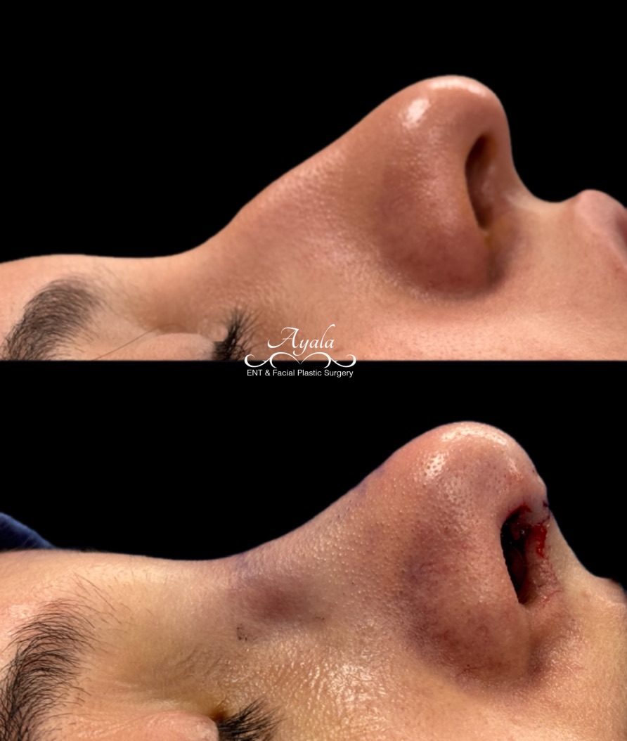 Instagram post by Dr. Carlos Ayala: ✨ Intraoperative transformation. A glimpse at the immediate structural refinement achieved during rhinoplasty. Final results will continue t…
